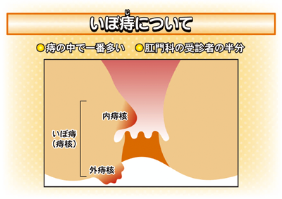 痔の種類 class=