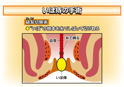 痔の種類 class=