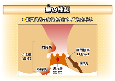 痔の種類 class=