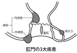 痔の種類 class=