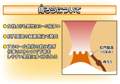 痔の種類 class=
