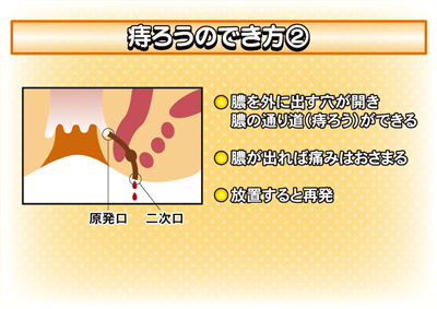 痔の種類 class=